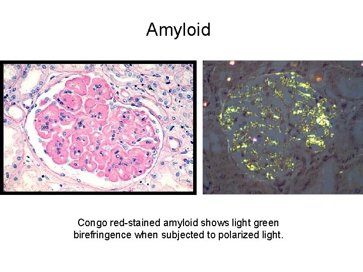 Amyloid Congo red-stained amyloid shows light green birefringence when subjected to polarized light. 