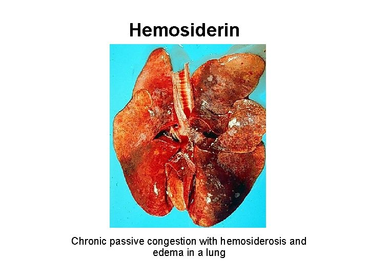 Hemosiderin Chronic passive congestion with hemosiderosis and edema in a lung 