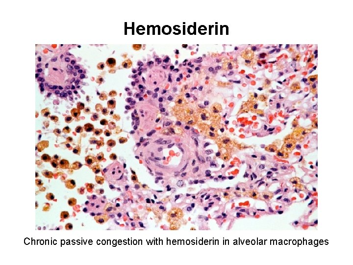 Hemosiderin Chronic passive congestion with hemosiderin in alveolar macrophages 