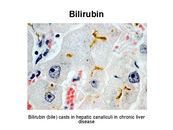 Bilirubin (bile) casts in hepatic canaliculi in chronic liver disease 