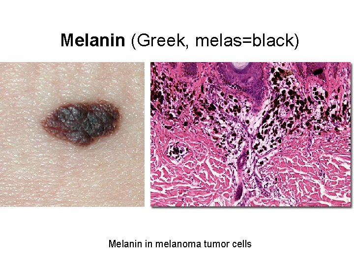 Melanin (Greek, melas=black) Melanin in melanoma tumor cells 