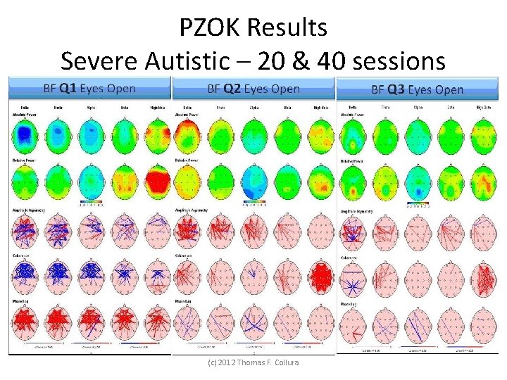 PZOK Results Severe Autistic – 20 & 40 sessions (c) 2012 Thomas F. Collura