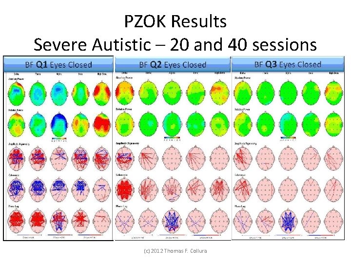 PZOK Results Severe Autistic – 20 and 40 sessions (c) 2012 Thomas F. Collura