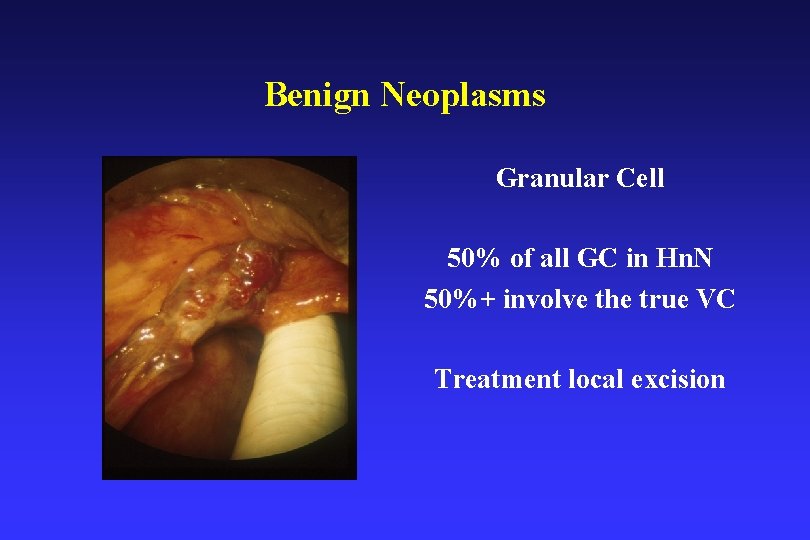 Benign Neoplasms Granular Cell 50% of all GC in Hn. N 50%+ involve the