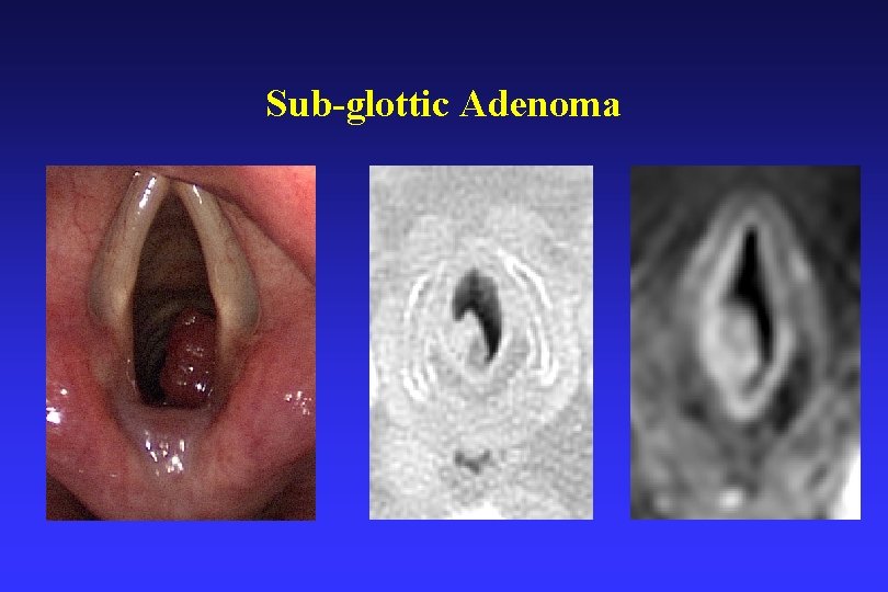 Sub-glottic Adenoma 