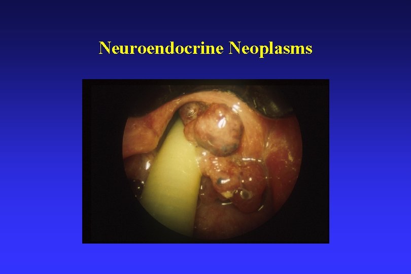 Neuroendocrine Neoplasms 