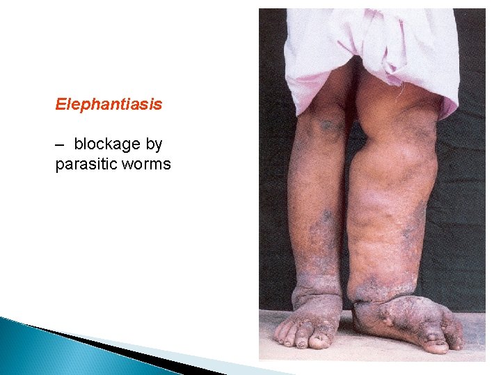 Elephantiasis – blockage by parasitic worms 