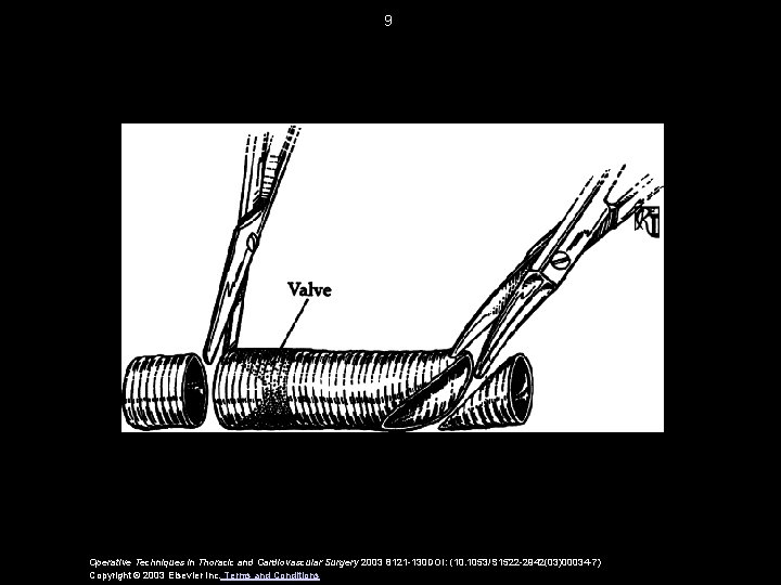 9 Operative Techniques in Thoracic and Cardiovascular Surgery 2003 8121 -130 DOI: (10. 1053/S