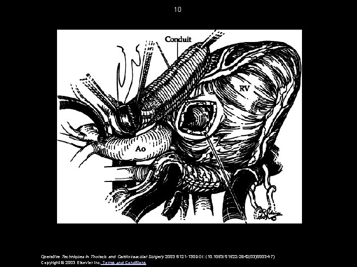 10 Operative Techniques in Thoracic and Cardiovascular Surgery 2003 8121 -130 DOI: (10. 1053/S
