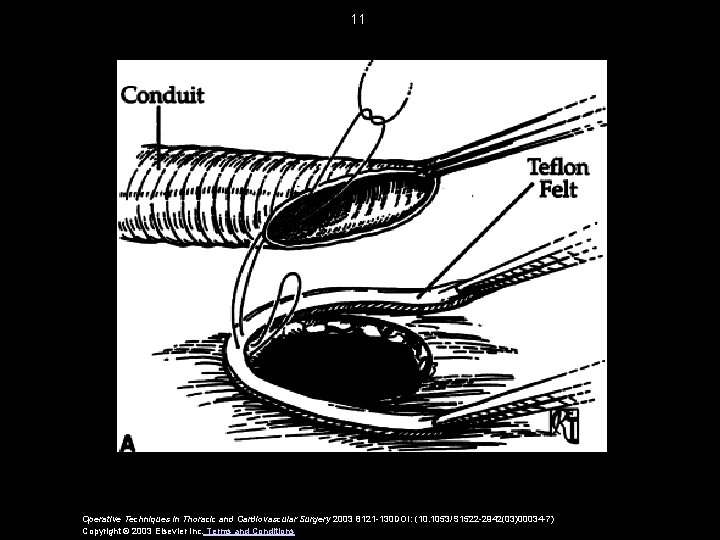 11 Operative Techniques in Thoracic and Cardiovascular Surgery 2003 8121 -130 DOI: (10. 1053/S