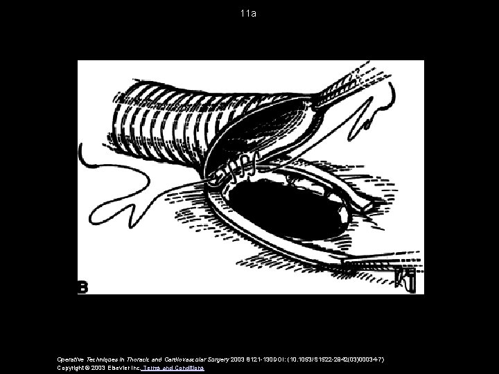 11 a Operative Techniques in Thoracic and Cardiovascular Surgery 2003 8121 -130 DOI: (10.