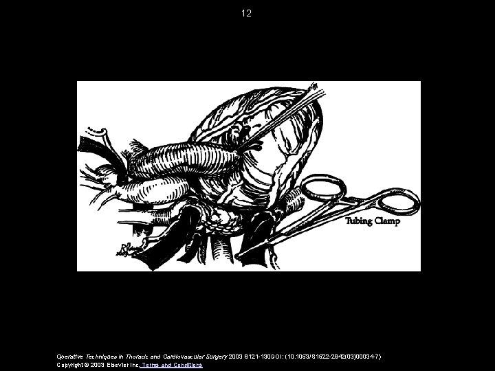 12 Operative Techniques in Thoracic and Cardiovascular Surgery 2003 8121 -130 DOI: (10. 1053/S