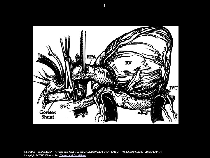 1 Operative Techniques in Thoracic and Cardiovascular Surgery 2003 8121 -130 DOI: (10. 1053/S