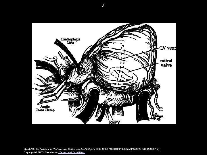 2 Operative Techniques in Thoracic and Cardiovascular Surgery 2003 8121 -130 DOI: (10. 1053/S