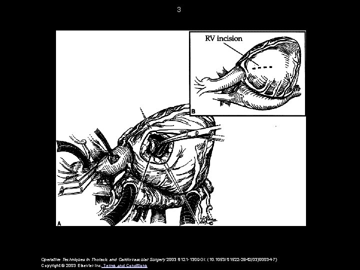 3 Operative Techniques in Thoracic and Cardiovascular Surgery 2003 8121 -130 DOI: (10. 1053/S