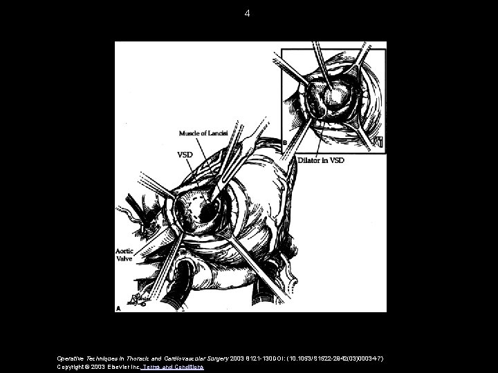 4 Operative Techniques in Thoracic and Cardiovascular Surgery 2003 8121 -130 DOI: (10. 1053/S