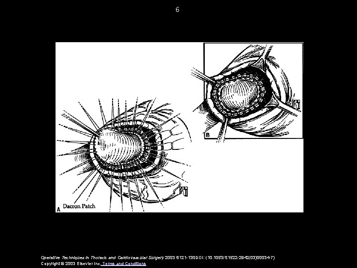 6 Operative Techniques in Thoracic and Cardiovascular Surgery 2003 8121 -130 DOI: (10. 1053/S