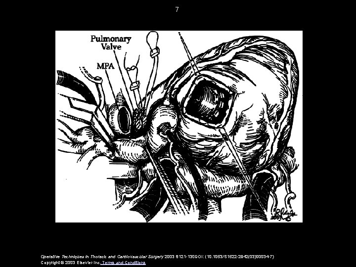 7 Operative Techniques in Thoracic and Cardiovascular Surgery 2003 8121 -130 DOI: (10. 1053/S