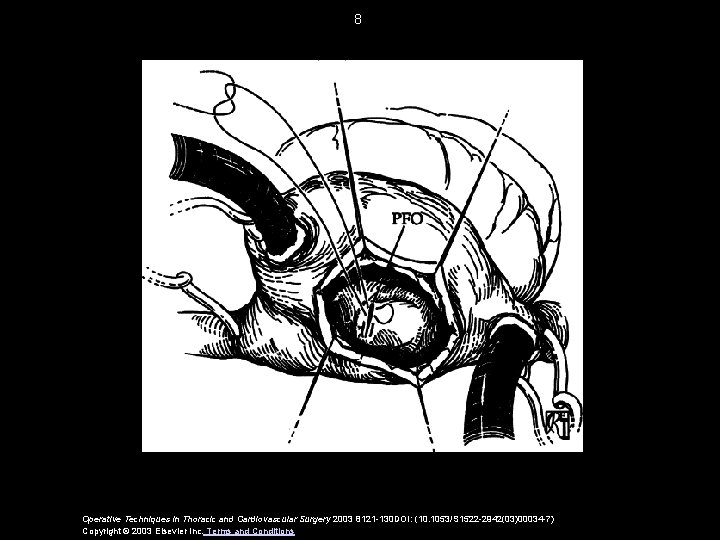 8 Operative Techniques in Thoracic and Cardiovascular Surgery 2003 8121 -130 DOI: (10. 1053/S