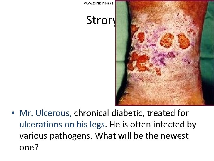 www. zilniklinika. cz Strory 3 • Mr. Ulcerous, chronical diabetic, treated for ulcerations on