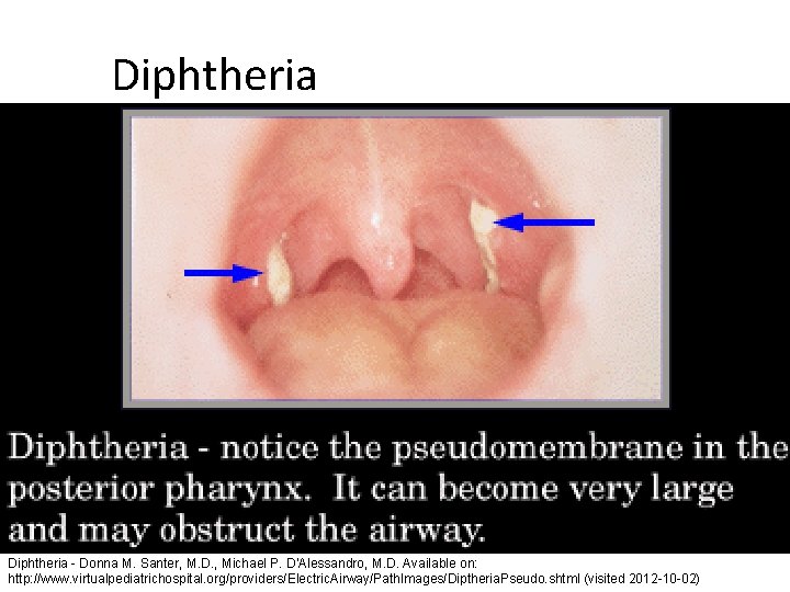 Diphtheria - Donna M. Santer, M. D. , Michael P. D'Alessandro, M. D. Available