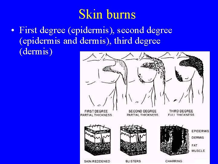 Skin burns • First degree (epidermis), second degree (epidermis and dermis), third degree (dermis)