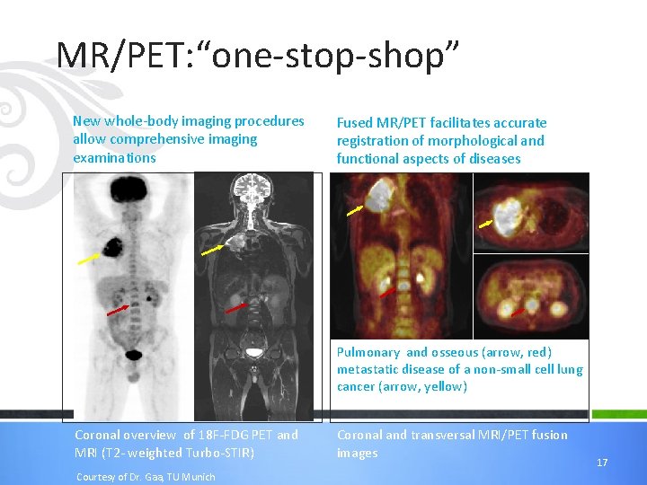 MR/PET: “one-stop-shop” New whole-body imaging procedures allow comprehensive imaging examinations Fused MR/PET facilitates accurate