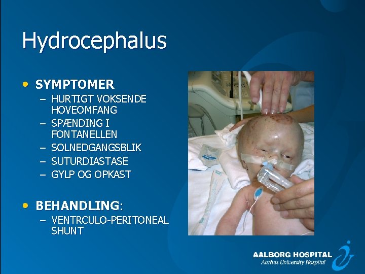 Hydrocephalus • SYMPTOMER – HURTIGT VOKSENDE HOVEOMFANG – SPÆNDING I FONTANELLEN – SOLNEDGANGSBLIK –