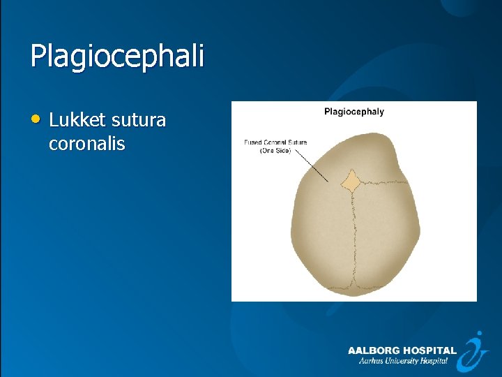 Plagiocephali • Lukket sutura coronalis 