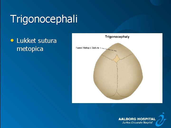 Trigonocephali • Lukket sutura metopica 