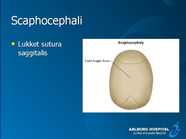 Scaphocephali • Lukket sutura saggitalis 