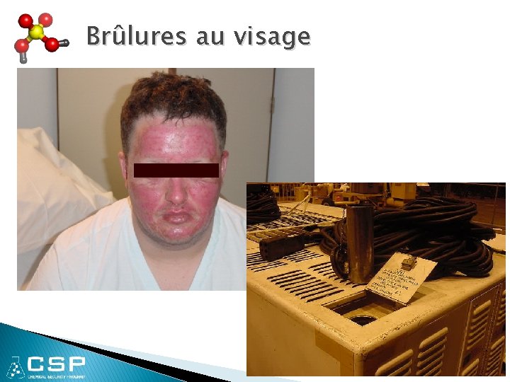 Brûlures au visage 9 