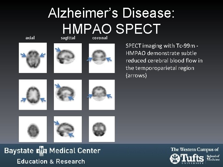 axial Alzheimer’s Disease: HMPAO SPECT sagittal coronal SPECT imaging with Tc-99 m HMPAO demonstrate axial Alzheimer’s Disease: HMPAO SPECT sagittal coronal SPECT imaging with Tc-99 m HMPAO demonstrate