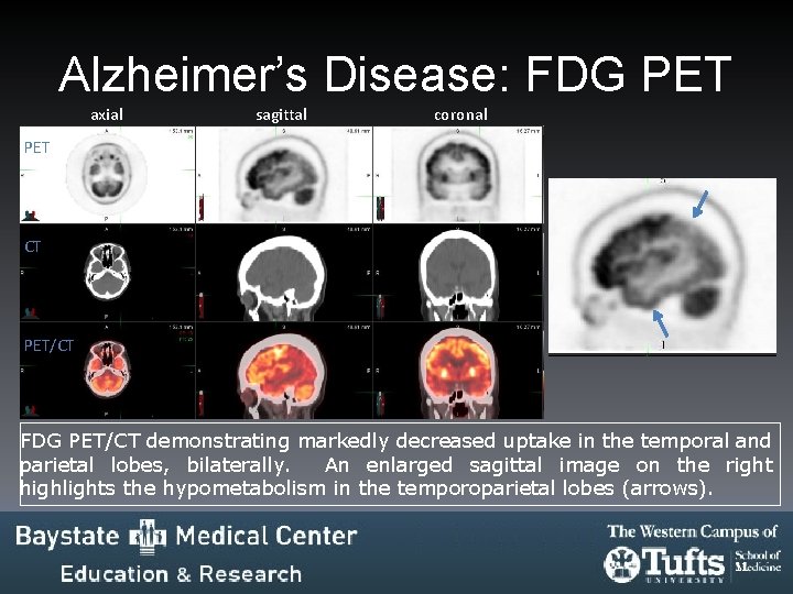 Alzheimer’s Disease: FDG PET axial sagittal coronal PET CT PET/CT FDG PET/CT demonstrating markedly Alzheimer’s Disease: FDG PET axial sagittal coronal PET CT PET/CT FDG PET/CT demonstrating markedly