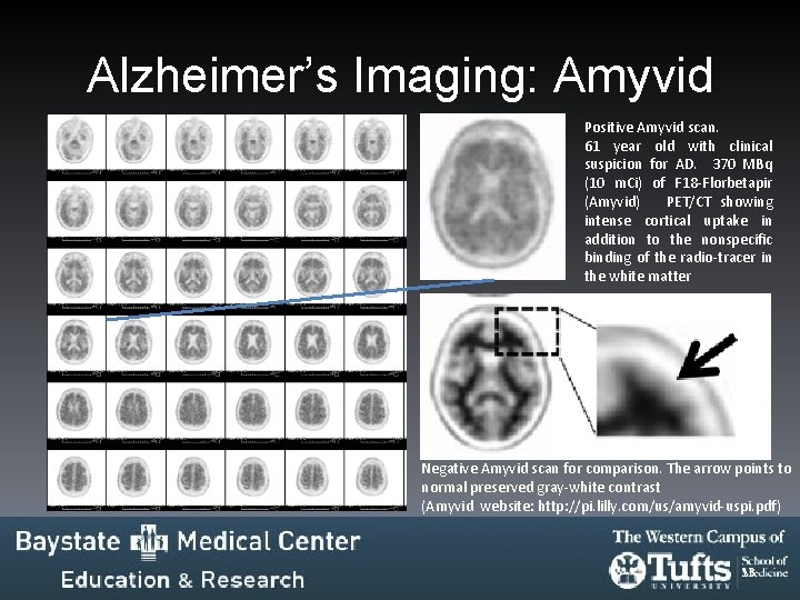 Alzheimer’s Imaging: Amyvid Positive Amyvid scan. 61 year old with clinical suspicion for AD. Alzheimer’s Imaging: Amyvid Positive Amyvid scan. 61 year old with clinical suspicion for AD.