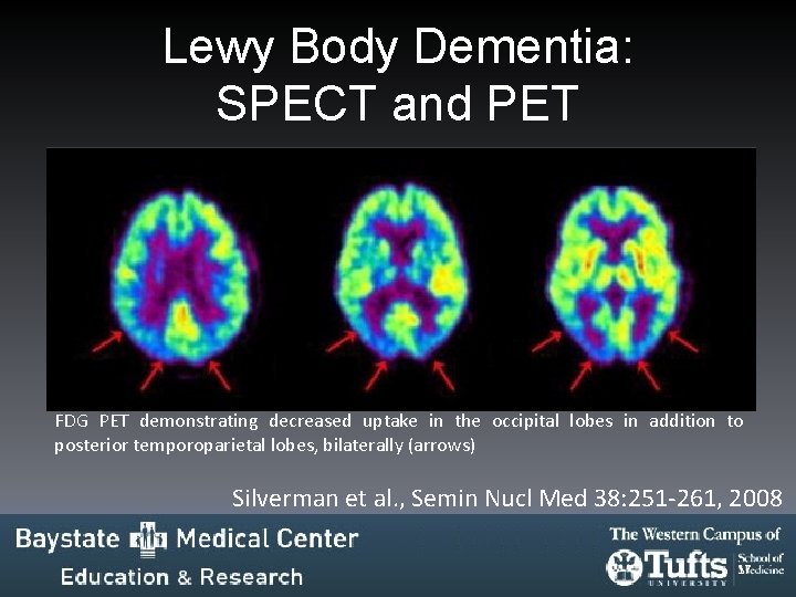 Lewy Body Dementia: SPECT and PET FDG PET demonstrating decreased uptake in the occipital Lewy Body Dementia: SPECT and PET FDG PET demonstrating decreased uptake in the occipital