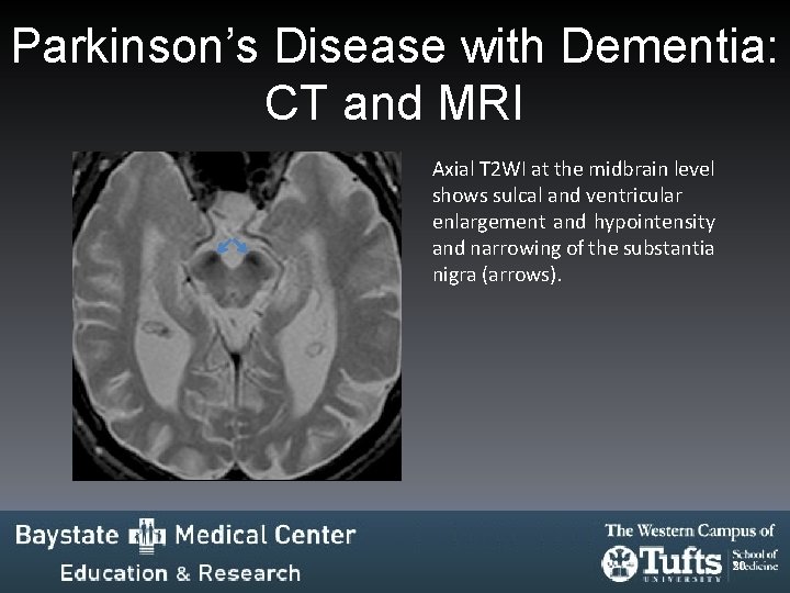 Parkinson’s Disease with Dementia: CT and MRI Axial T 2 WI at the midbrain Parkinson’s Disease with Dementia: CT and MRI Axial T 2 WI at the midbrain