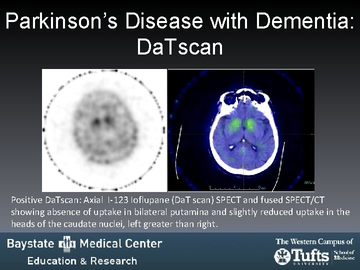 Parkinson’s Disease with Dementia: Da. Tscan Positive Da. Tscan: Axial I-123 Ioflupane (Da. T Parkinson’s Disease with Dementia: Da. Tscan Positive Da. Tscan: Axial I-123 Ioflupane (Da. T