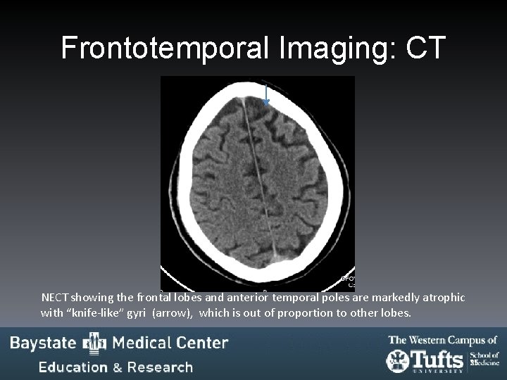 Frontotemporal Imaging: CT NECT showing the frontal lobes and anterior temporal poles are markedly Frontotemporal Imaging: CT NECT showing the frontal lobes and anterior temporal poles are markedly