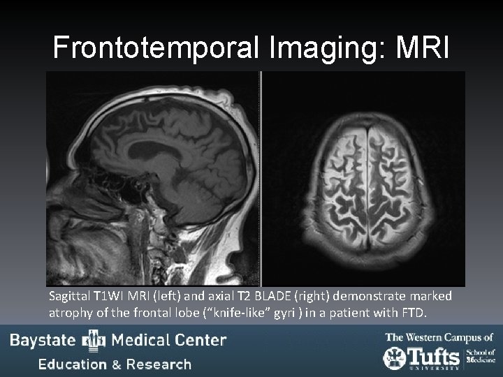 Frontotemporal Imaging: MRI Sagittal T 1 WI MRI (left) and axial T 2 BLADE Frontotemporal Imaging: MRI Sagittal T 1 WI MRI (left) and axial T 2 BLADE