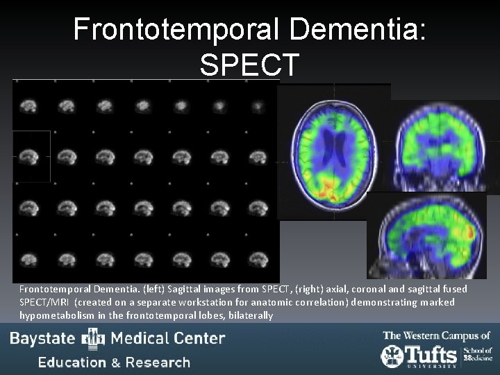 Frontotemporal Dementia: SPECT » » Frontotemporal Dementia. (left) Sagittal images from SPECT, (right) axial, Frontotemporal Dementia: SPECT » » Frontotemporal Dementia. (left) Sagittal images from SPECT, (right) axial,