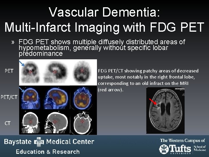 Vascular Dementia: Multi-Infarct Imaging with FDG PET » FDG PET shows multiple diffusely distributed Vascular Dementia: Multi-Infarct Imaging with FDG PET » FDG PET shows multiple diffusely distributed
