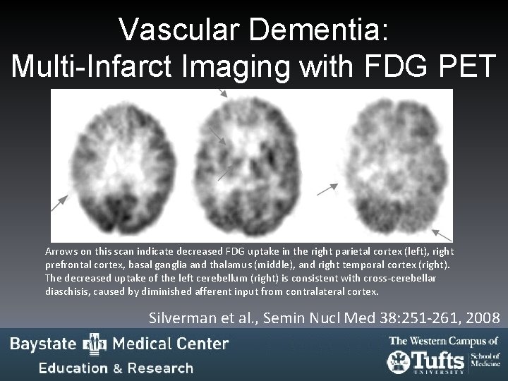 Vascular Dementia: Multi-Infarct Imaging with FDG PET Arrows on this scan indicate decreased FDG Vascular Dementia: Multi-Infarct Imaging with FDG PET Arrows on this scan indicate decreased FDG