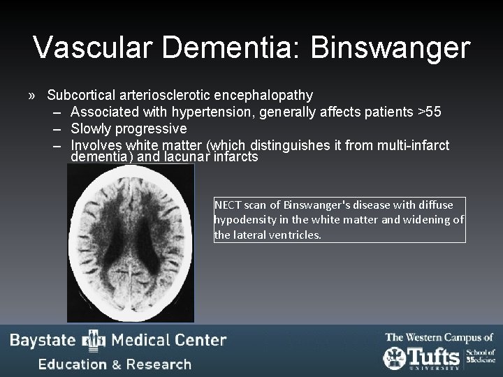 Vascular Dementia: Binswanger » Subcortical arteriosclerotic encephalopathy – Associated with hypertension, generally affects patients Vascular Dementia: Binswanger » Subcortical arteriosclerotic encephalopathy – Associated with hypertension, generally affects patients