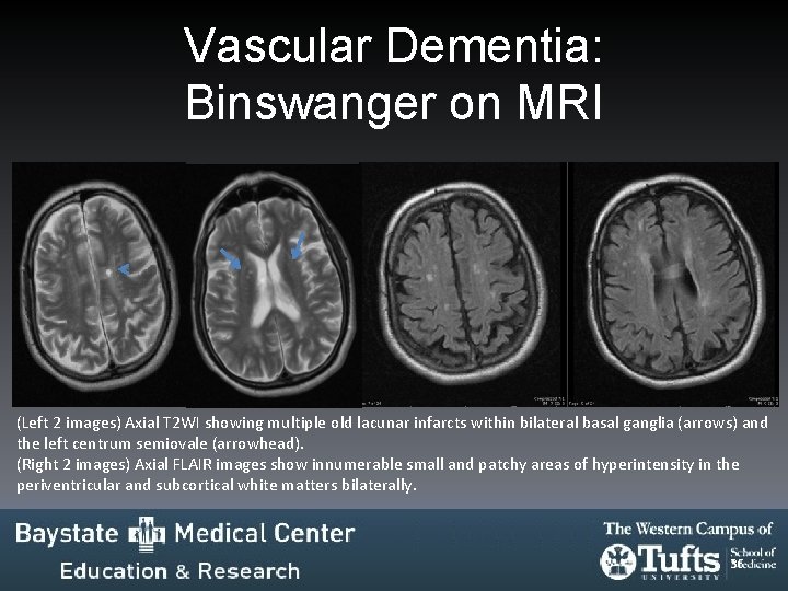 Vascular Dementia: Binswanger on MRI (Left 2 images) Axial T 2 WI showing multiple Vascular Dementia: Binswanger on MRI (Left 2 images) Axial T 2 WI showing multiple