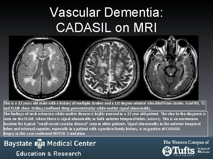 Vascular Dementia: CADASIL on MRI This is a 32 years old male with a Vascular Dementia: CADASIL on MRI This is a 32 years old male with a