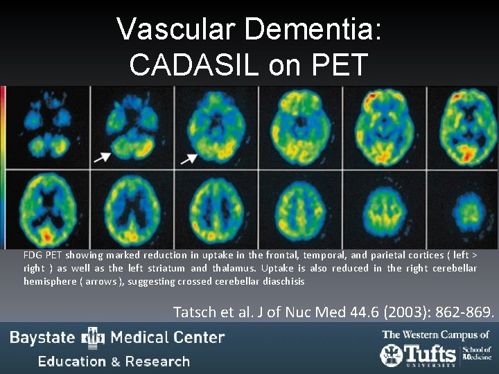Vascular Dementia: CADASIL on PET FDG PET showing marked reduction in uptake in the Vascular Dementia: CADASIL on PET FDG PET showing marked reduction in uptake in the