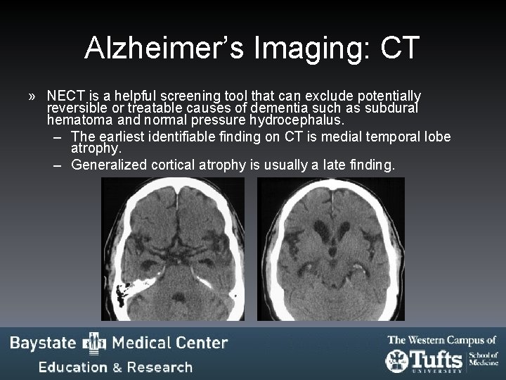 Alzheimer’s Imaging: CT » NECT is a helpful screening tool that can exclude potentially Alzheimer’s Imaging: CT » NECT is a helpful screening tool that can exclude potentially