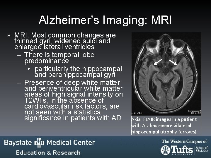 Alzheimer’s Imaging: MRI » MRI: Most common changes are thinned gyri, widened sulci and Alzheimer’s Imaging: MRI » MRI: Most common changes are thinned gyri, widened sulci and