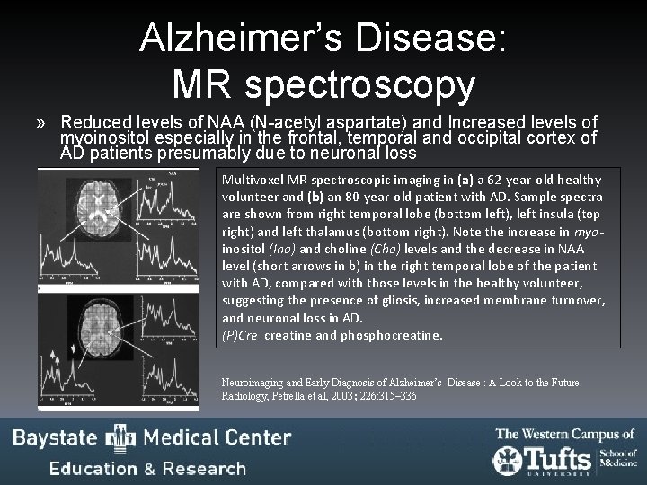 Alzheimer’s Disease: MR spectroscopy » Reduced levels of NAA (N-acetyl aspartate) and Increased levels Alzheimer’s Disease: MR spectroscopy » Reduced levels of NAA (N-acetyl aspartate) and Increased levels